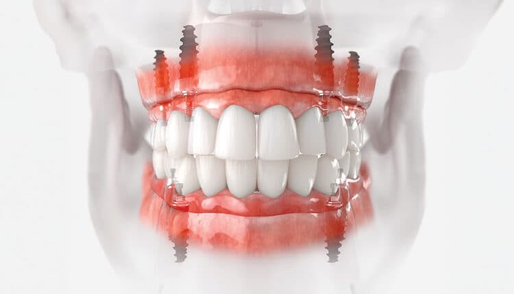 Why Venice Patients Choose Stunning Dentistry