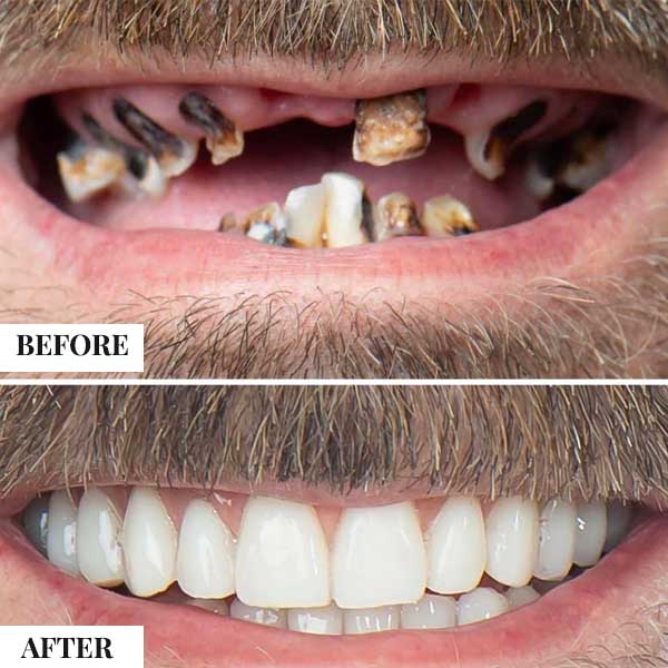 What Is the All-on-4 Treatment Concept?