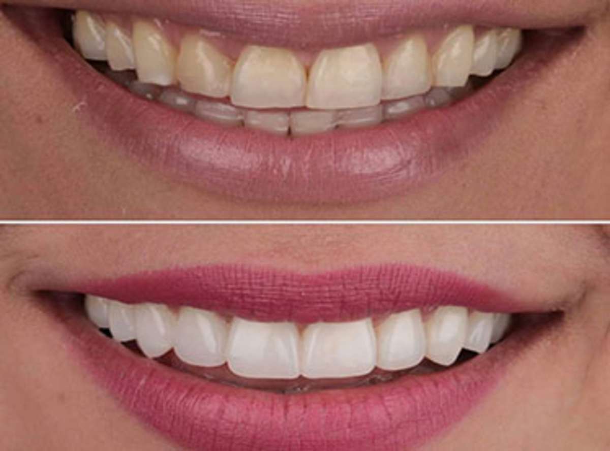 Margaret W. - Turin - Smile Design (20 Veneers)
