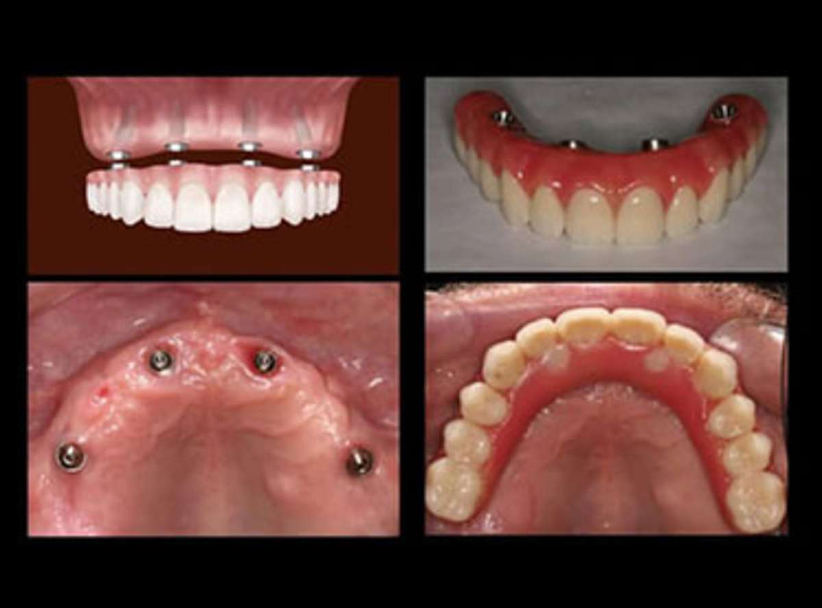 Clinical Gates, Stunning Dentistry's Immediate-Load Acceptance Protocol (SD-TIAD-02)