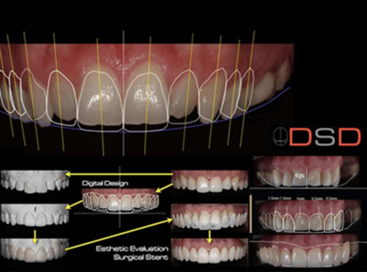 Digital Smile Design (DSD) planning workflow