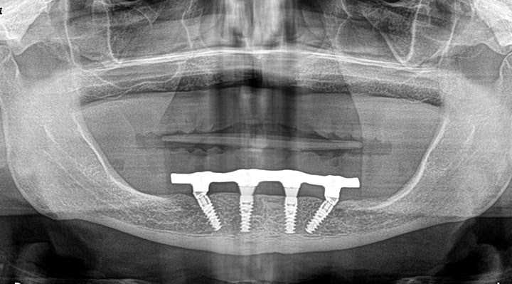 Full Decision Ladder, Graft vs Short vs Tilted vs Zygomatic vs All-on-4