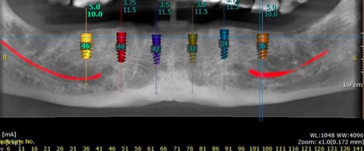 Consequences of Delaying Full-Arch Treatment