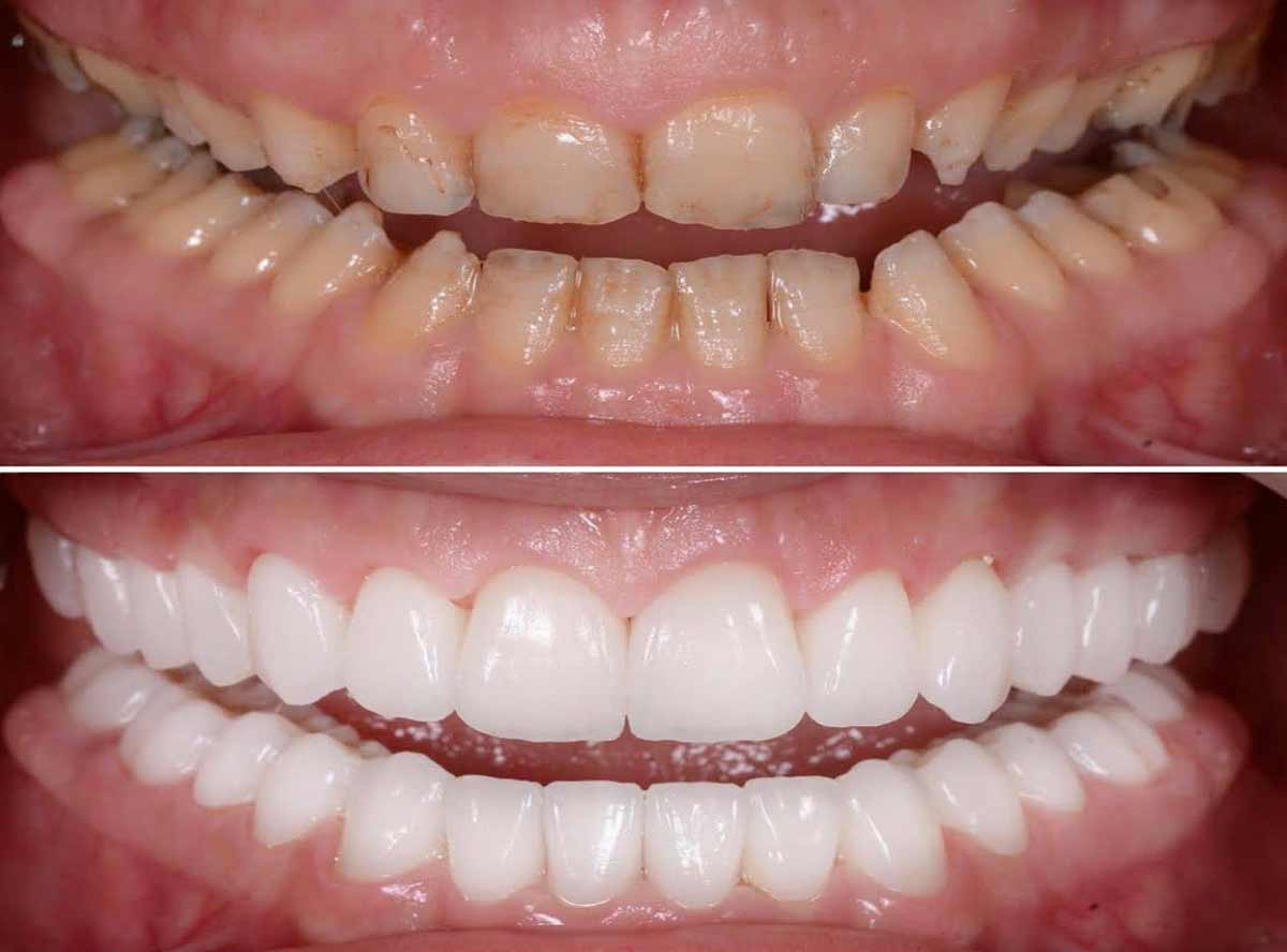 Why Choose Full Mouth Rehabilitation, The Clinical Case