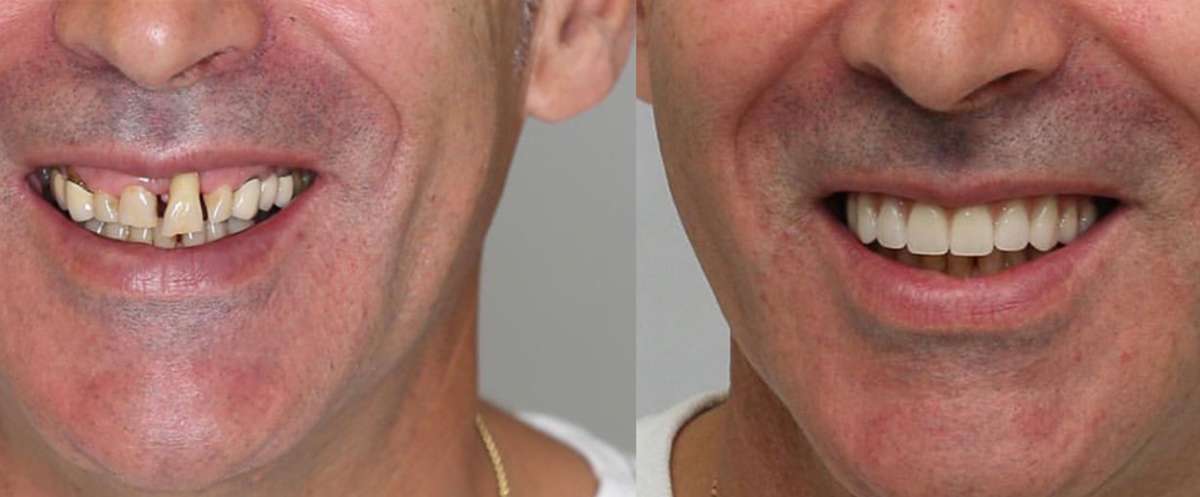 What Is Full Mouth Rehabilitation?
