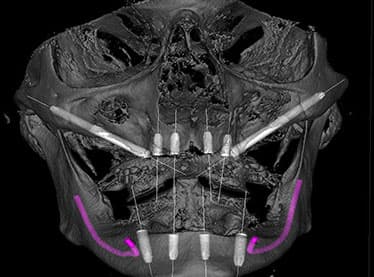 What Are Zygomatic Implants?