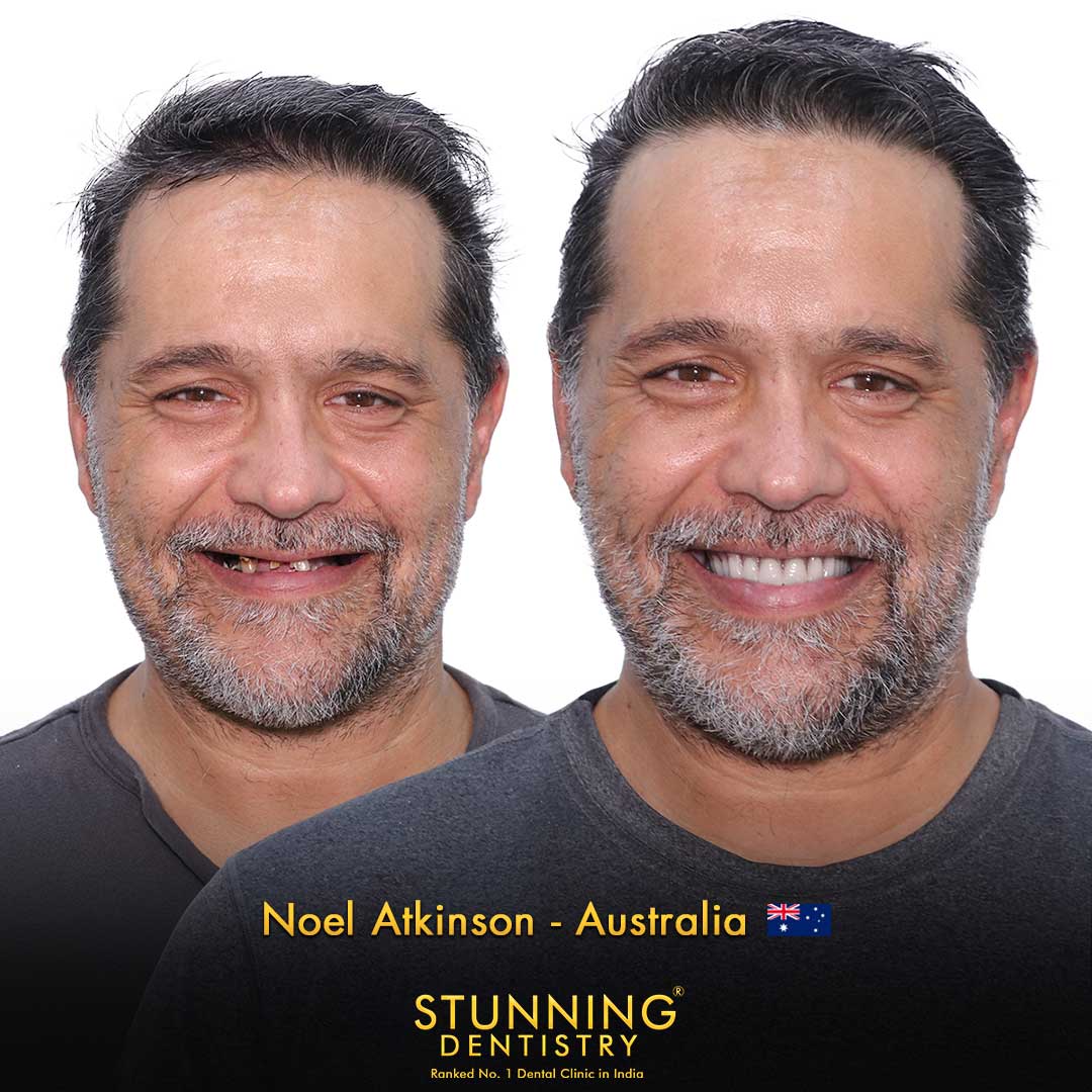 Full-arch implant transformation