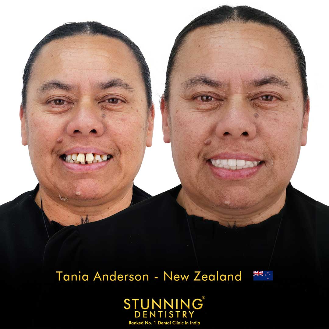 Dental implant before and after case 7