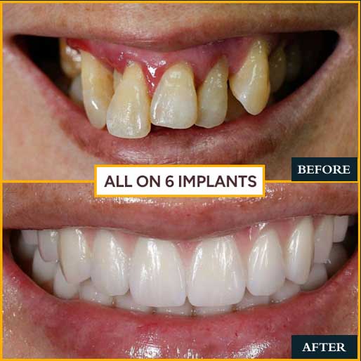 Porcelain Veneers - photo 4