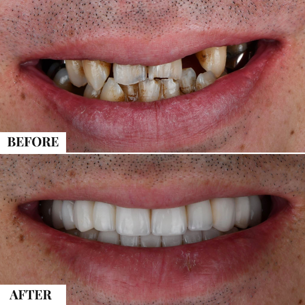Dental Implants - photo 1
