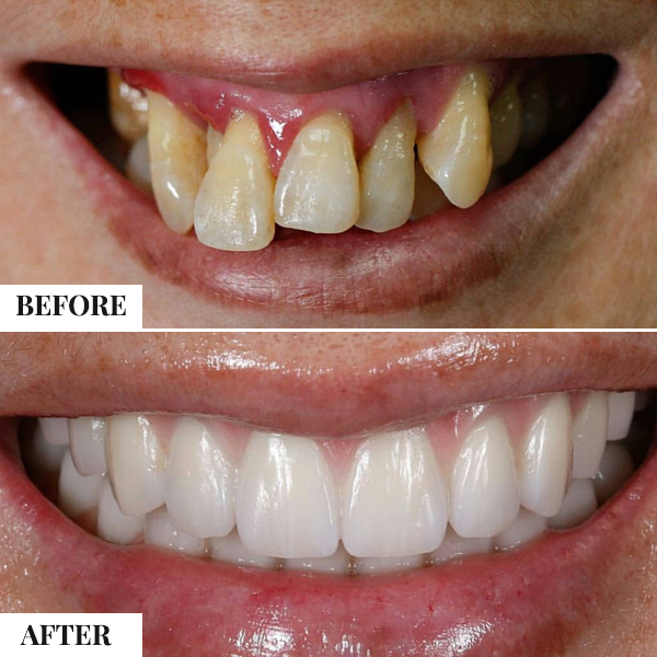 Dental Implants - photo 2