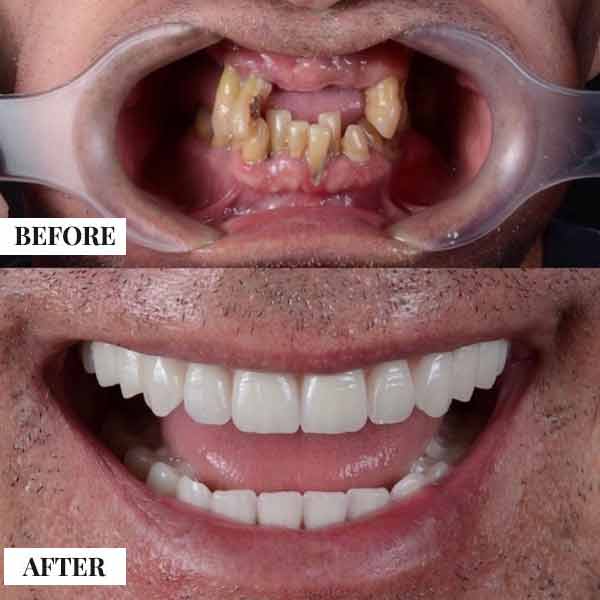 Dental Implants - photo 3