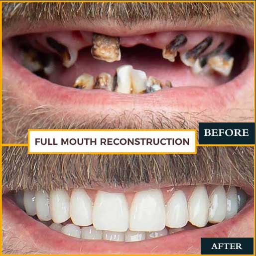 Full Mouth Rehabilitation - photo 4