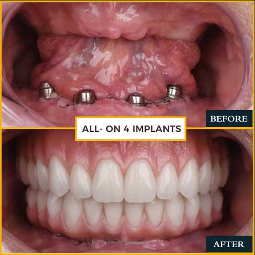 Smile Makeover - photo 3