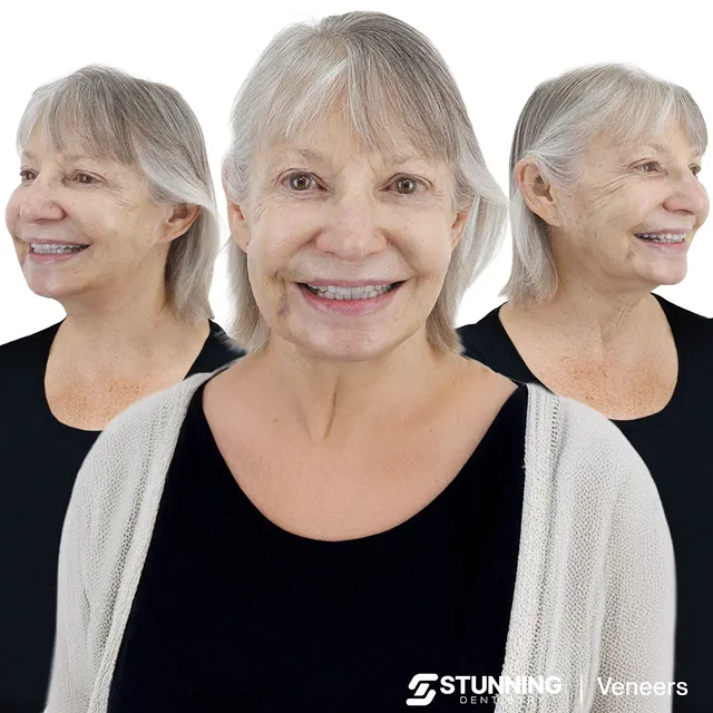 Smile Makeover, USA – photo 2
