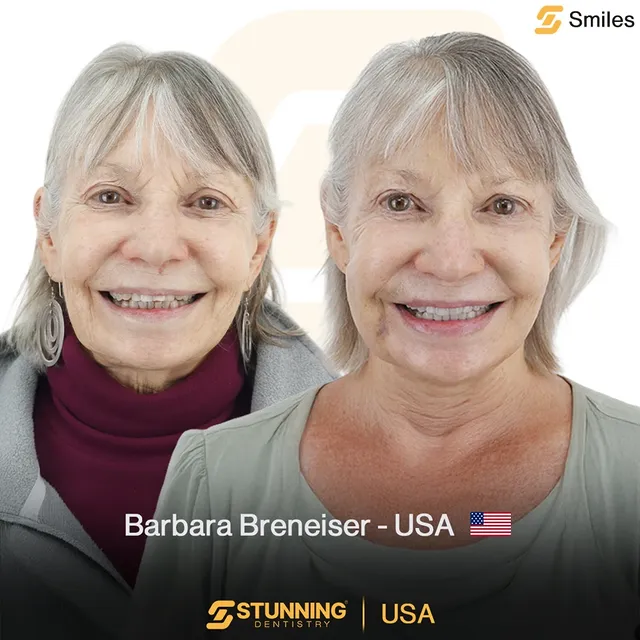 Smile Makeover, USA – photo 3