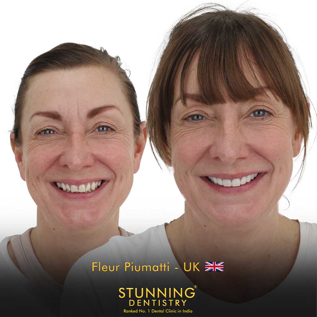 Porcelain Veneers - photo 3