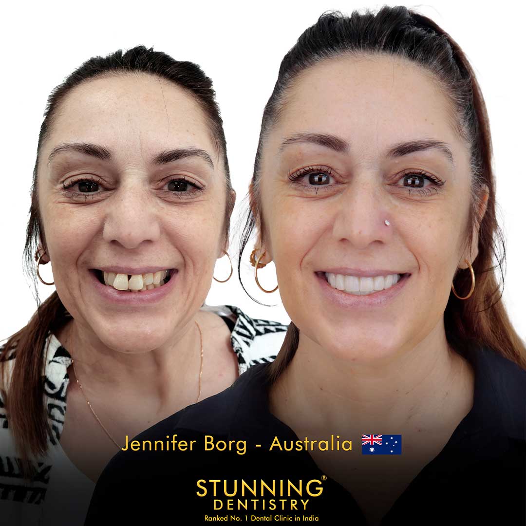 Full Mouth Rehabilitation - photo 2