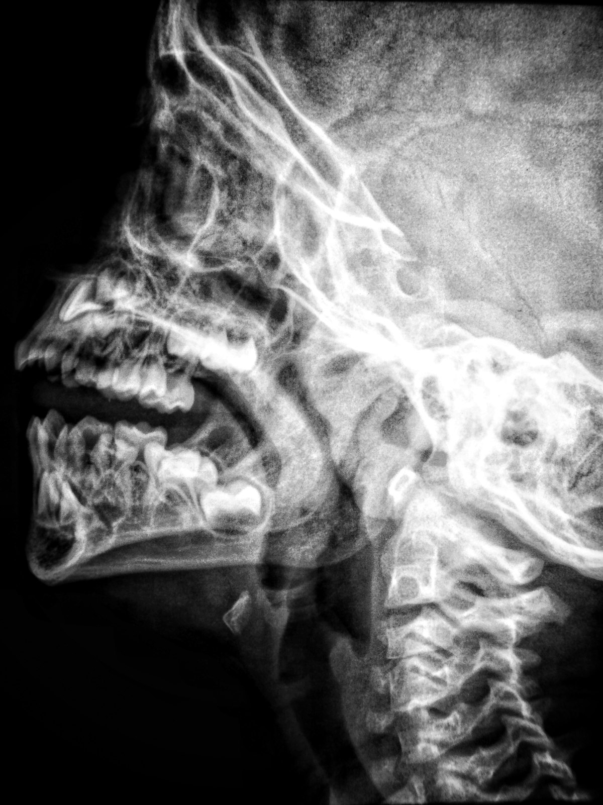 Digital imaging and CBCT planning