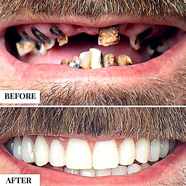 Full mouth rehabilitation case comparing dental tourism options