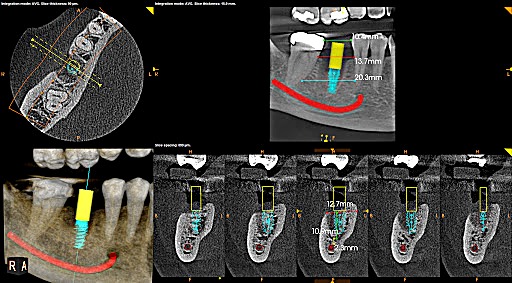 Single dental implant clinical case