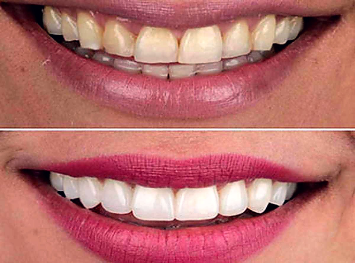 Porcelain veneers before and after